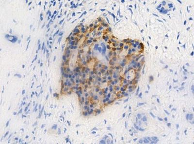DOK3 Antibody - DF3331 at 1/100 staining human pancreatic carcinoma by IHC-P.