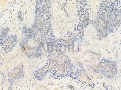 STRAD Antibody - DF3334 at 1/100 staining human breast carcinoma by IHC-P.