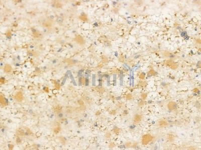 AKAP14 Antibody - DF3340 at 1/100 staining human astrocytoma by IHC-P.