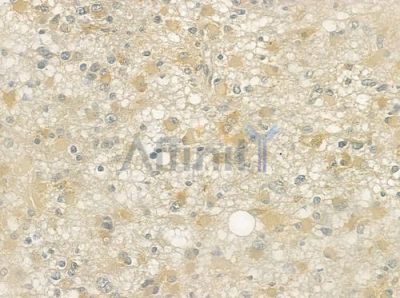 CAMK5 Antibody - DF3351 at 1/100 staining human astrocytoma by IHC-P.