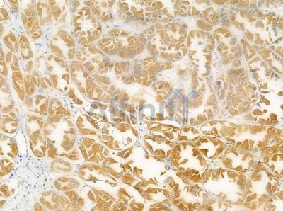 ANKK1 Antibody - DF3357 at 1/100 staining human renal cell carcinoma by IHC-P.