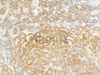ANKK1 Antibody - DF3357 at 1/100 staining human renal cell carcinoma by IHC-P.