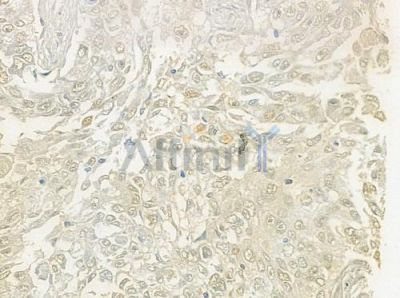 ZNF596 Antibody - DF3365 at 1/100 staining human lung squamous cell carcinoma by IHC-P.