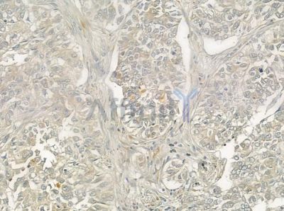 BRI3B Antibody - DF3376 at 1/100 staining human lung squamous cell carcinoma by IHC-P.
