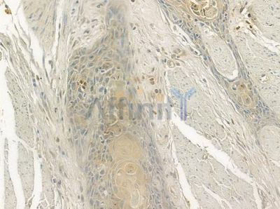 BRF1 Antibody - DF3388 at 1/100 staining human esophageal carcinoma by IHC-P.