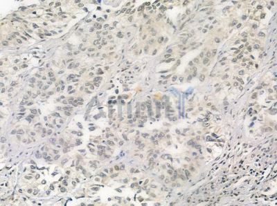 PKNOX2 Antibody - DF3402 at 1/100 staining human lung squamous cell carcinoma by IHC-P.