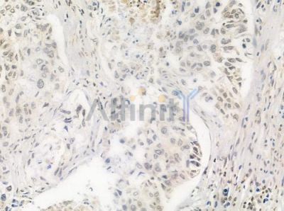 PKNOX2 Antibody - DF3402 at 1/100 staining human lung squamous cell carcinoma by IHC-P.