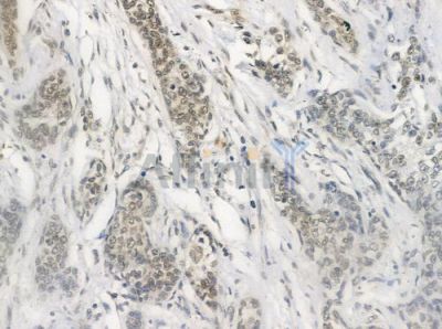 PKNOX2 Antibody - DF3402 at 1/100 staining human breast carcinoma by IHC-P.