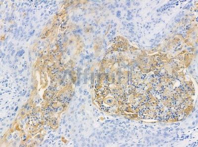 MAP3K3 Antibody - DF3410 at 1/100 staining human pancreatic carcinoma by IHC-P.