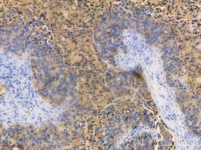 MAP3K3 Antibody - DF3410 at 1/100 staining human large cell lung carcinoma by IHC-P.