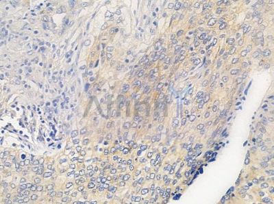 YTHDF1 Antibody - DF3422 at 1/100 staining human cervical carcinoma by IHC-P.
