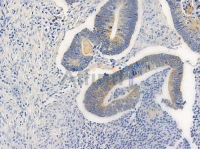 YTHDF1 Antibody - DF3422 at 1/100 staining human colon carcinoma by IHC-P.