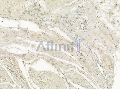XRN2 Antibody - DF3429 at 1/100 staining human esophageal carcinoma by IHC-P.