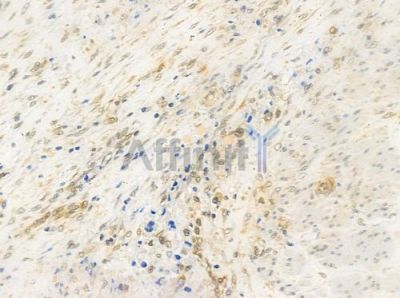 HMG20B Antibody - DF3458 at 1/100 staining human prostate carcinoma by IHC-P.