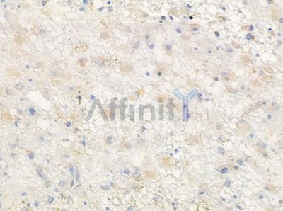 14-3-3 gamma Antibody - DF3493 at 1/100 staining human astrocytoma by IHC-P.