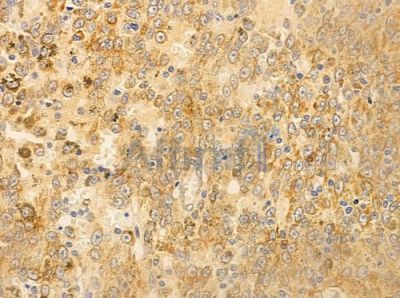 AHSA1 Antibody - DF3513 at 1/100 staining human melanoma by IHC-P.