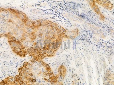 Cytochrome P450 24A1 Antibody - DF3568 at 1/100 staining human esophageal carcinoma by IHC-P.