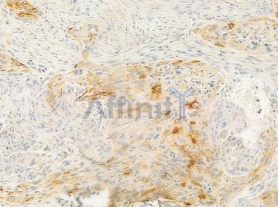 Cytochrome P450 24A1 Antibody - DF3568 at 1/100 staining human tongue carcinoma by IHC-P.
