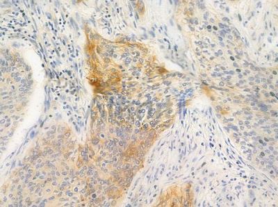 Cytochrome P450 24A1 Antibody - DF3568 at 1/100 staining human cervical carcinoma by IHC-P.