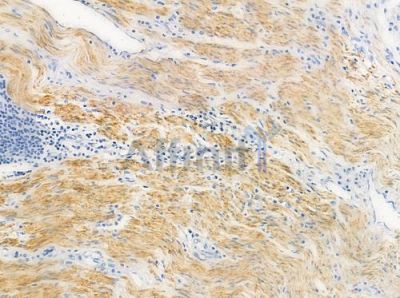 Cytochrome P450 3A43 Antibody - DF3584 at 1/100 staining human colon carcinoma by IHC-P.
