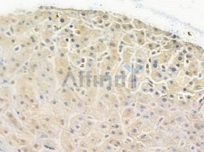 HSPB2 Antibody - DF3601 at 1/100 staining human hepatocellular carcinoma by IHC-P.