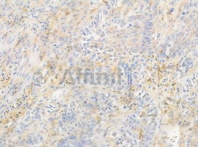 BCL2L2 Antibody - DF3607 at 1/100 staining human lung squamous cell carcinoma by IHC-P.