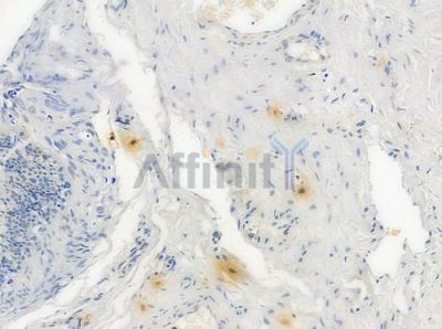 DNA Ligase IV Antibody - DF3613 at 1/100 staining human testicular cancer by IHC-P.