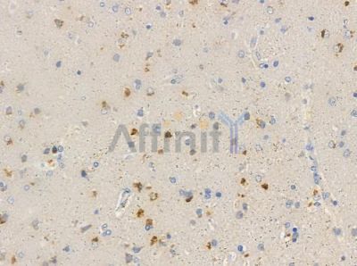 ELOA3 Antibody - DF3614 at 1/100 staining human glioblastoma by IHC-P.
