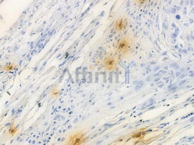 PHLDA1 Antibody - DF3626 at 1/100 staining human tongue carcinoma by IHC-P.