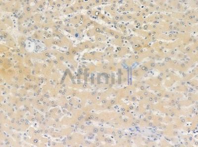 MRPS12 Antibody - DF3646 at 1/100 staining human hepatocellular carcinoma by IHC-P.