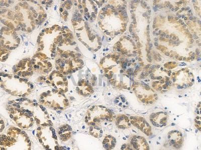 MRPL24 Antibody - DF3666 at 1/100 staining human renal cell carcinoma by IHC-P.