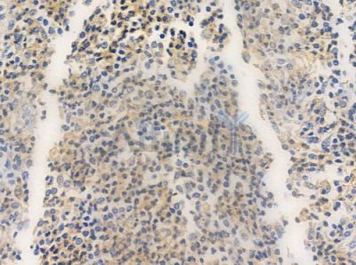 PGLS Antibody - DF3715 at 1/100 staining human colon carcinoma by IHC-P.