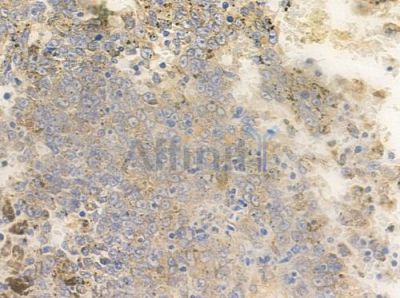 PGLS Antibody - DF3715 at 1/100 staining human melanoma by IHC-P.
