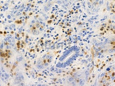 ACBD6 Antibody - DF3732 at 1/100 staining human esophageal carcinoma by IHC-P.