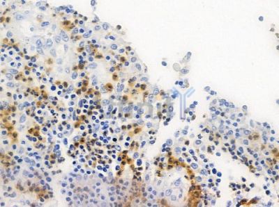 ACBD6 Antibody - DF3732 at 1/100 staining human colon carcinoma by IHC-P.