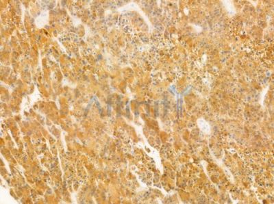 KAL1 Antibody - DF3780 at 1/100 staining human hepatocellular carcinoma by IHC-P.
