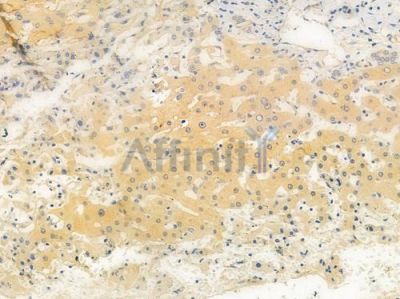APOF Antibody - DF3784 at 1/100 staining human hepatocellular carcinoma by IHC-P.