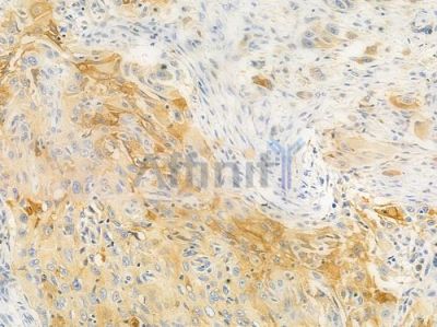 APOF Antibody - DF3784 at 1/100 staining human tongue carcinoma by IHC-P.