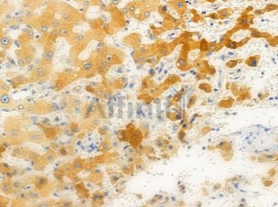 ARSG Antibody - DF3797 at 1/100 staining human hepatocellular carcinoma by IHC-P.