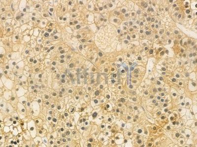 GUSBL1 Antibody - DF3844 at 1/100 staining human hepatocellular carcinoma by IHC-P.