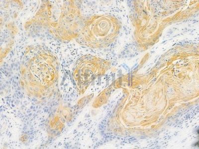 BMP3 Antibody - DF3848 at 1/100 staining human esophageal carcinoma by IHC-P.