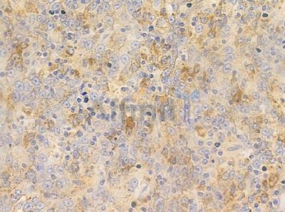 BAIAP2L1 Antibody - DF3853 at 1/100 staining human melanoma by IHC-P.