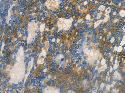 Calcipressin 1 Antibody - DF3861 at 1/100 staining human ovarian carcinoma by IHC-P.