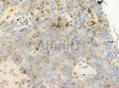 CAPN9 Antibody - DF3869 at 1/100 staining human melanoma by IHC-P.