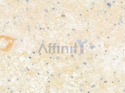 GBA3 Antibody - DF3979 at 1/100 staining human astrocytoma by IHC-P.