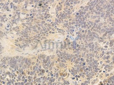 POLD1 Antibody - DF3997 at 1/100 staining human small cell lung carcinoma by IHC-P.