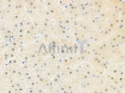POLD1 Antibody - DF3997 at 1/100 staining human cervical carcinoma by IHC-P.
