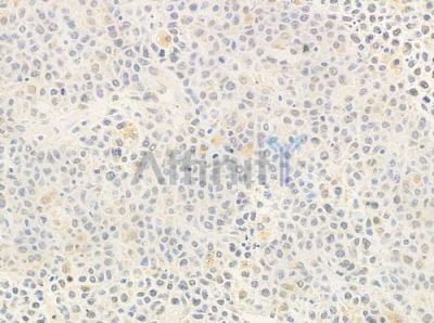 POLD1 Antibody - DF3997 at 1/100 staining human non-Hodgkin lymphoma by IHC-P.