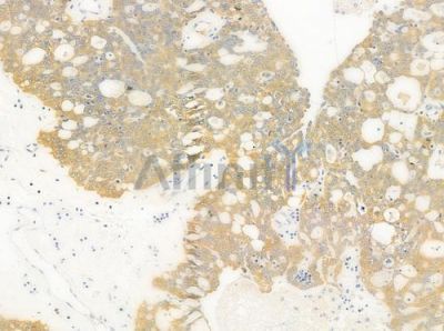 DNAJB11 Antibody - DF4010 at 1/100 staining human ovarian carcinoma by IHC-P.