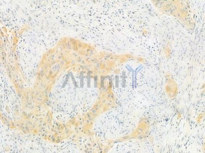 DNAJB11 Antibody - DF4010 at 1/100 staining human tongue carcinoma by IHC-P.